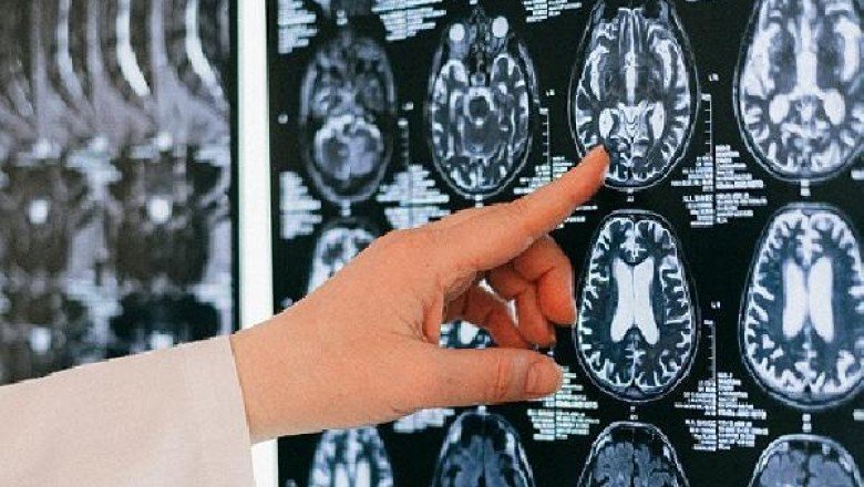 Serebral palsi; çocuklarda ilk 3 yaşa dikkat