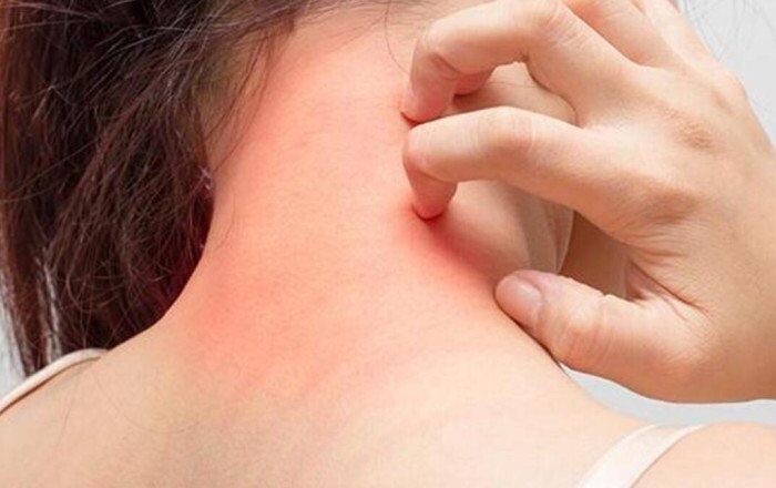 Uyuz Tedavisinde Sirke Kullanımı Nasıl Olur? Evde Uyuz Nasıl Geçer?