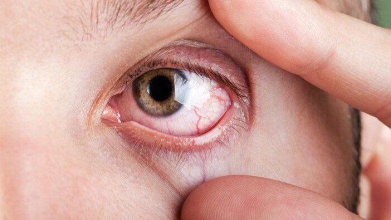 Gözler alarm veriyor: Görme kaybına yol açabilir!