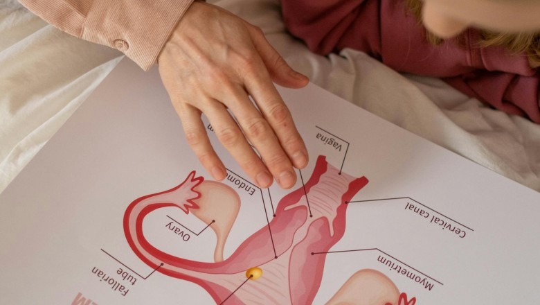 Endometriozis nedir? Belirtileri ve tedavi yöntemleri