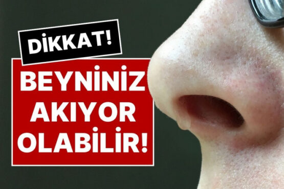 Geçmeyen Burun Akıntısının Nedeni Nedir? Beyin Sıvınız Akıyor Olabilir!